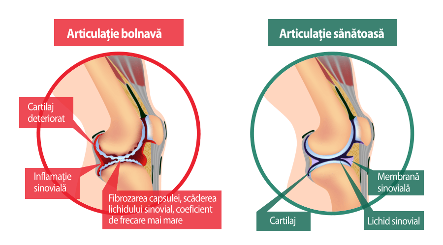 tratamentul medicației cu artroză spinală tratamentul artrozei stadiului 2 al genunchiului